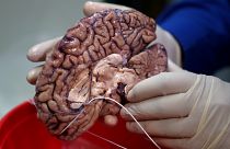 Médicos españoles logran aumentar la vida de pacientes con metástasis cerebral de 4 a 15 meses