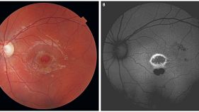  Εννιάχρονο αγόρι έχασε σχεδόν την όρασή του παίζοντας με έναν δείκτη λέιζερ