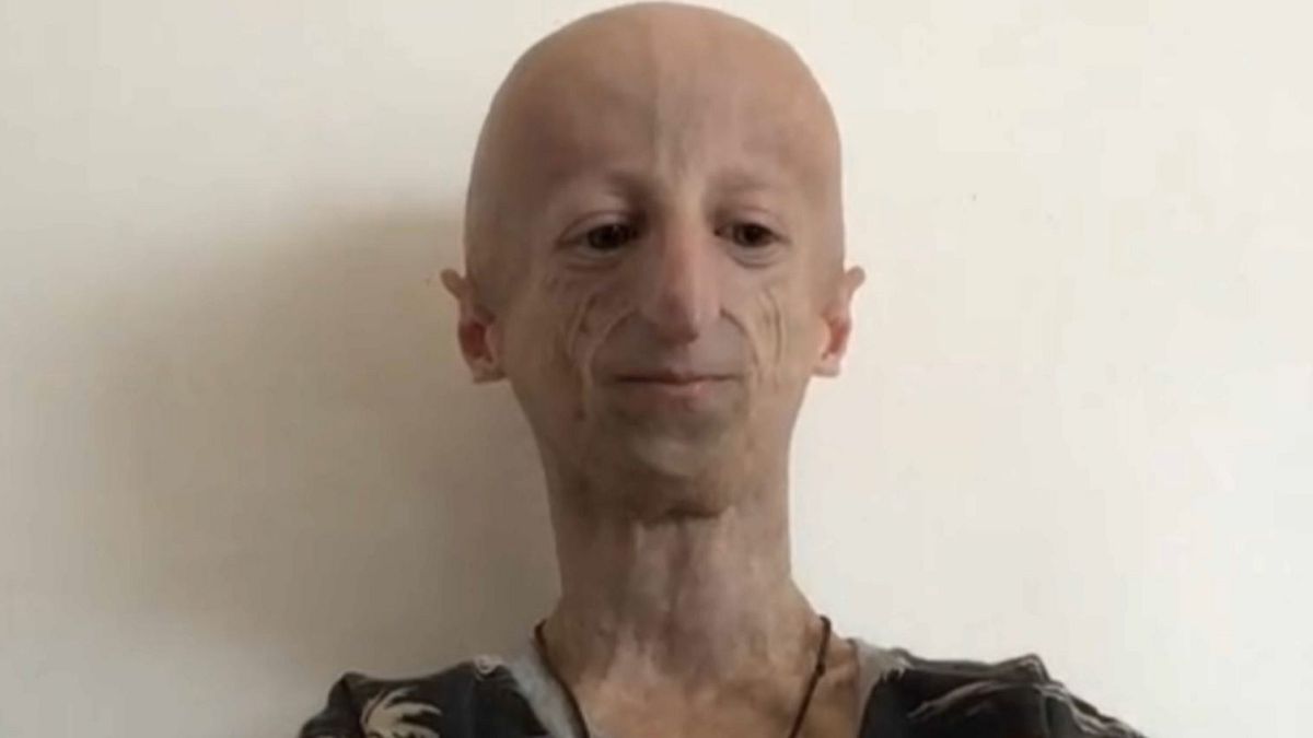 Divulgazione, ricerca e racconta fondi: la sfida di Sammy Basso alla progeria