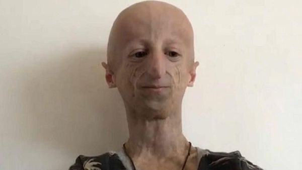 Meet Sammy The 22 Year Old Who Looks Like An Old Man Euronews