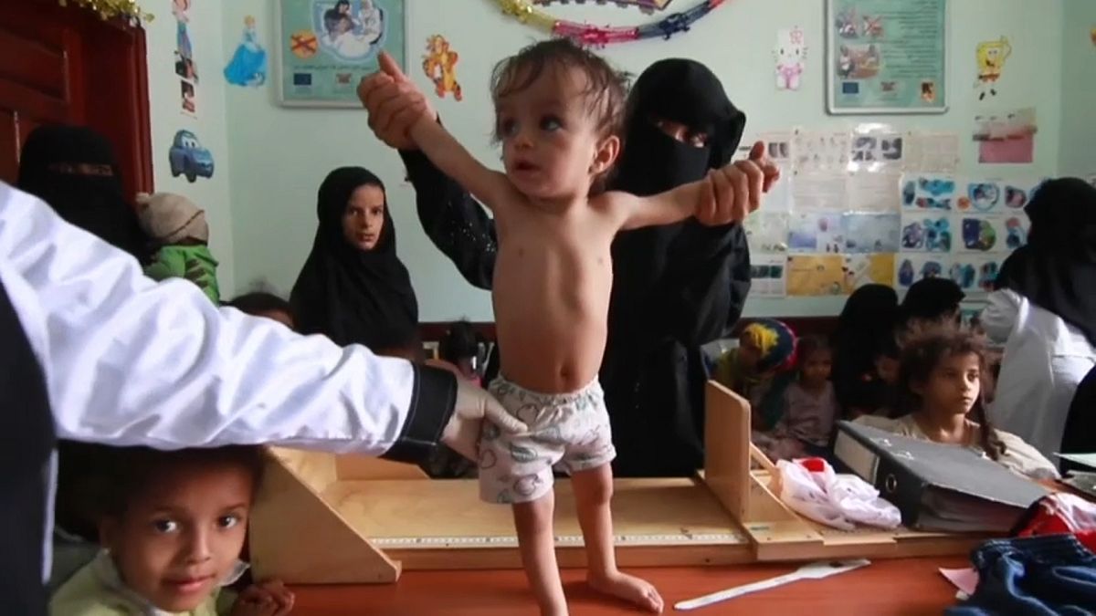 آمال معلقة على "جنيف" لإغاثة أطفال اليمن الذين فتكت بهم الحرب والفقر وسوء التغذية