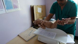 A malnourished baby is weighed in Sanaa, Yemen on Sept. 11, 2018