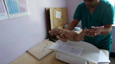 A malnourished baby is weighed in Sanaa, Yemen on Sept. 11, 2018