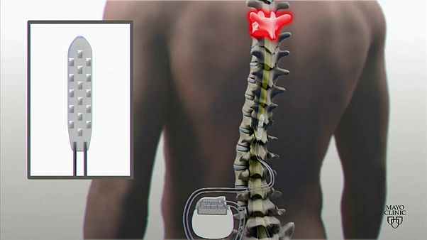 La stimolazione elettrica aiuta un ragazzo paraplegico a camminare di nuovo La stimolazione elettrica aiuta un ragazzo paraplegico a camminare di nuovo