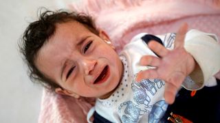 Kolera hastası Yemenli bir kız çocuğu Sanaa'da bir hastanede 11.10.2018