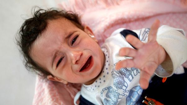 Kolera hastası Yemenli bir kız çocuğu Sanaa'da bir hastanede 11.10.2018 Kolera hastası Yemenli bir kız çocuğu Sanaa'da bir hastanede 11.10.2018