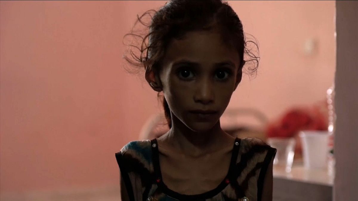 ازدياد أعداد الأطفال الذين يعانون سوء التغذية نتيجة الصراع في اليمن 