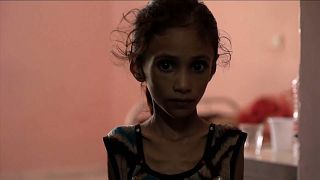 ازدياد أعداد الأطفال الذين يعانون سوء التغذية نتيجة الصراع في اليمن