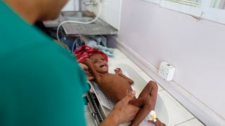 Πέθανε το κοριτσάκι-σύμβολο του λιμού στην Υεμένη