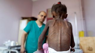 امل حسین، نماد کودکان گرسنه یمن درگذشت