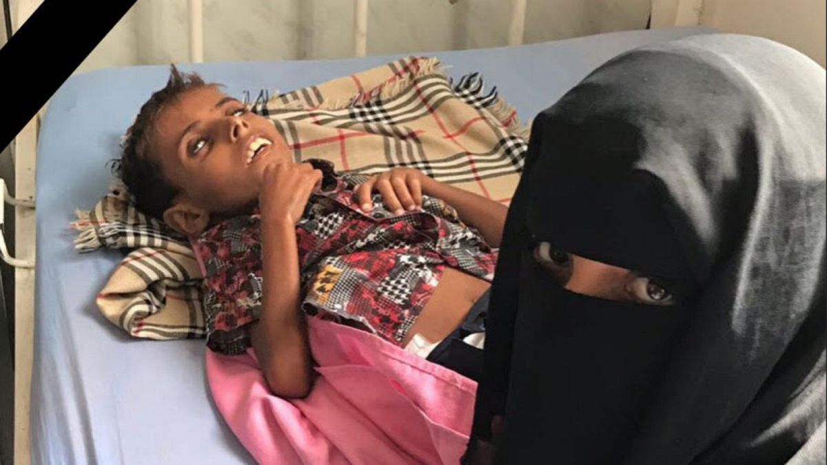  اليمن: بعد أمل حسين.. آدم علي يقضي بسبب سوء التغذية ونعي أممي "إلى جنات الخلد يا آدم"