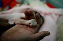Yemen'de açlıktan dolayı ölen 4 aylık bebek