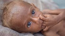 Nusair*, malnourished 13 month old boy