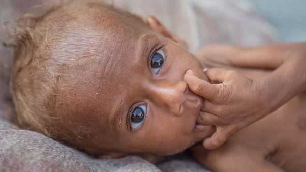 Save de Children dice que 85.000 menores de cinco años podrían haber muerto de hambre en Yemen Save de Children dice que 85.000 menores de cinco años podrían haber muerto de hambre en Yemen