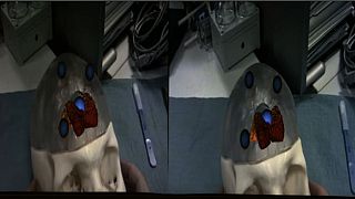 Augmented Reality to Change Surgery Techniques