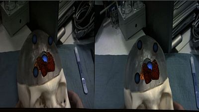 Augmented Reality to Change Surgery Techniques