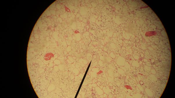 Liposarcoma Liposarcoma
