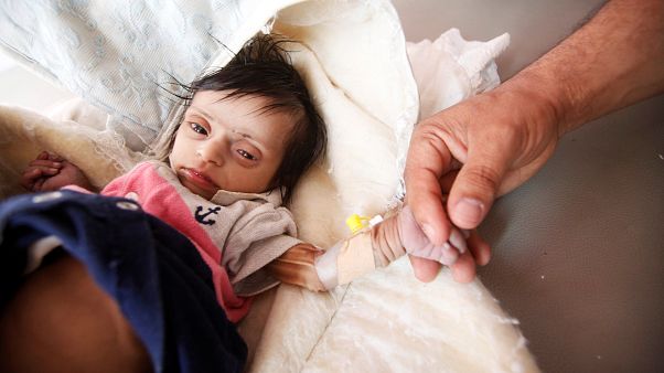 Yemen'de her 10 dakikada bir çocuk önlenebilir sebeplerden dolayı ölüyor Yemen'de her 10 dakikada bir çocuk önlenebilir sebeplerden dolayı ölüyor