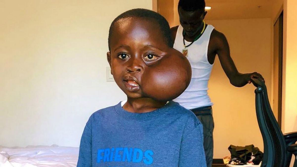 Yüzündeki tümörün alınması için ABD'de ameliyat edilen Kongolu çocuk yaşamını yitirdi