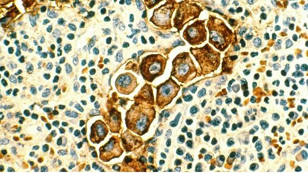 Kanserde yeni tedavi yöntemi: Hastalık gelecek nesiller için ölümcül olmayacak Kanserde yeni tedavi yöntemi: Hastalık gelecek nesiller için ölümcül olmayacak