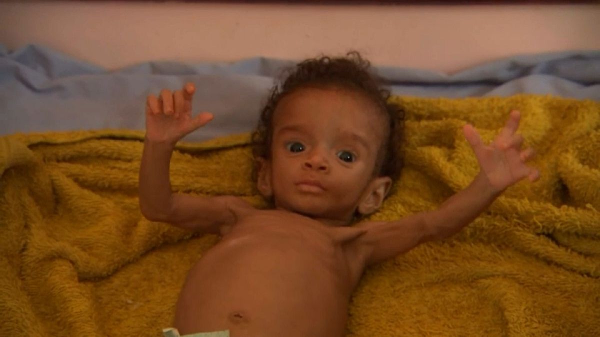 نداء استغاثة إلى العالم من أطفال يمنيين أنهكهم أكل أوراق الشجر