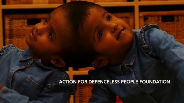 Coopération médicale pour séparer des siamoises du Bangladesh Coopération médicale pour séparer des siamoises du Bangladesh