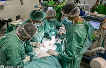 Hungarian doctors complete second phase of operations to separate head-conjoined twins