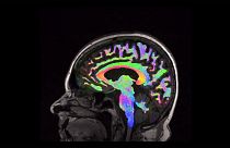 Estudo europeu vai analisar tratamento do traumatismo craniano