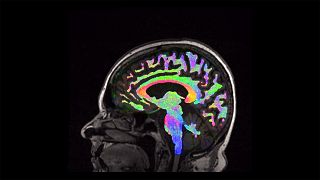 Schädel-Hirn-Trauma: MRT und bessere Behandlungstrategien
