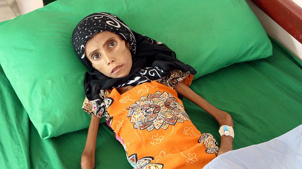بحران انسانی در یمن؛ دختر ۱۲ ساله با ۱۰ کیلو وزن بستری شد بحران انسانی در یمن؛ دختر ۱۲ ساله با ۱۰ کیلو وزن بستری شد