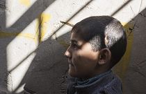 A child in Iraq who was struck in the head with shrapnel