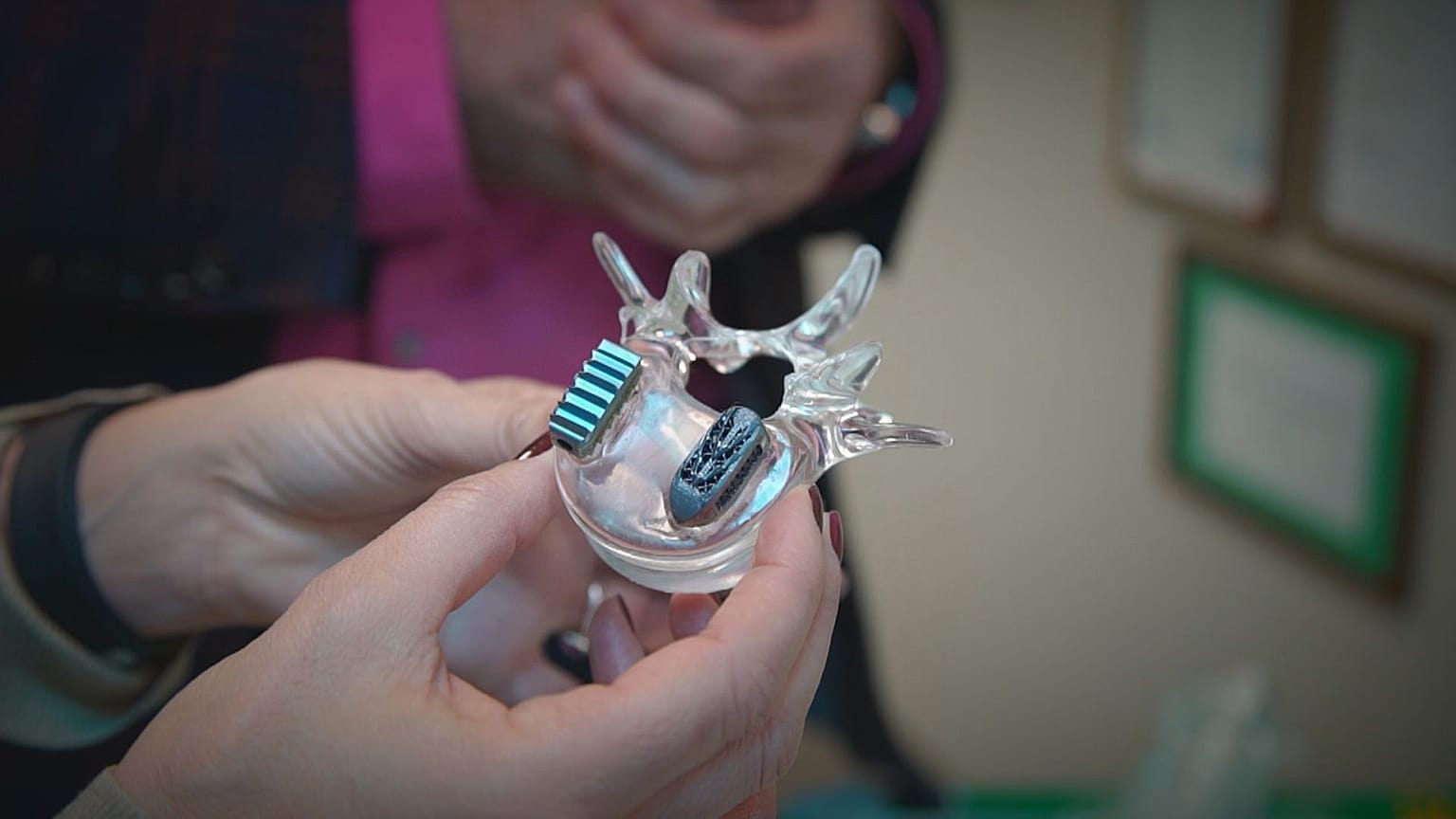 Custom 3D printed implants set to revolutionise spinal surgery | Euronews