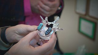 3D-nyomtatású csigolya-implantátumok Lengyelországból