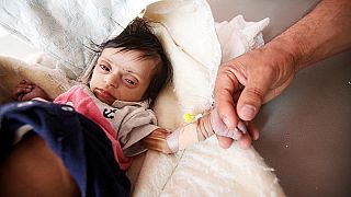Yemen’de 20 milyon kişi sağlık hizmetlerinden mahrum ve yeteri kadar beslenemiyor