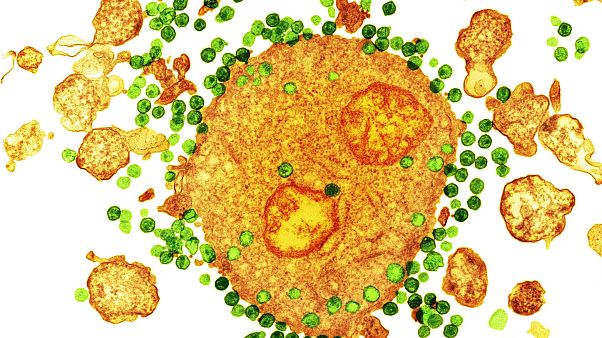 AIDS hastaları için umut artıyor: İkinci bir hasta HIV virüsünden tamamen kurtuldu AIDS hastaları için umut artıyor: İkinci bir hasta HIV virüsünden tamamen kurtuldu