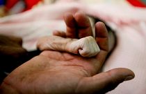 يمني يمسك بيد ابنته التي ماتت بسبب سوء التغذية في اليمن