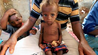 A malnourished girl sits on her father's lap in Hodeidah, Yemen