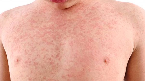 La rougeole est bel et bien de retour, les Etats-Unis particulièrement impactés La rougeole est bel et bien de retour, les Etats-Unis particulièrement impactés