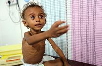 Yemen'de binlerce çocuk, hastalıkların pençesinde