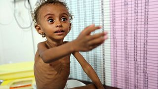 Yemen'de binlerce çocuk, hastalıkların pençesinde