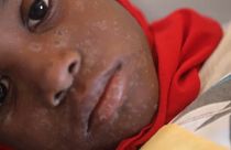 Kanyaró elleni azonnali oltást sürget a WHO