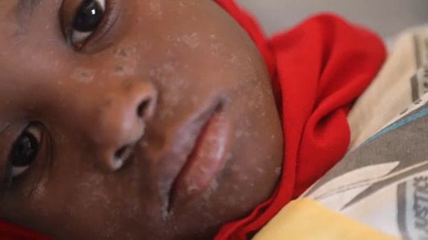 Kanyaró elleni azonnali oltást sürget a WHO Kanyaró elleni azonnali oltást sürget a WHO