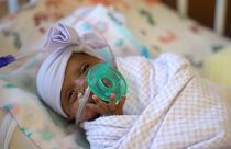 ABD'de 245 gram doğan dünyanın en küçük bebeği mucizevi şekilde hayata tutundu