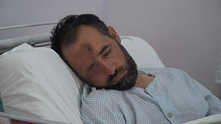 Bomba vitte el a koponyája egy részét az afgán férfinek- ma jár és beszél 