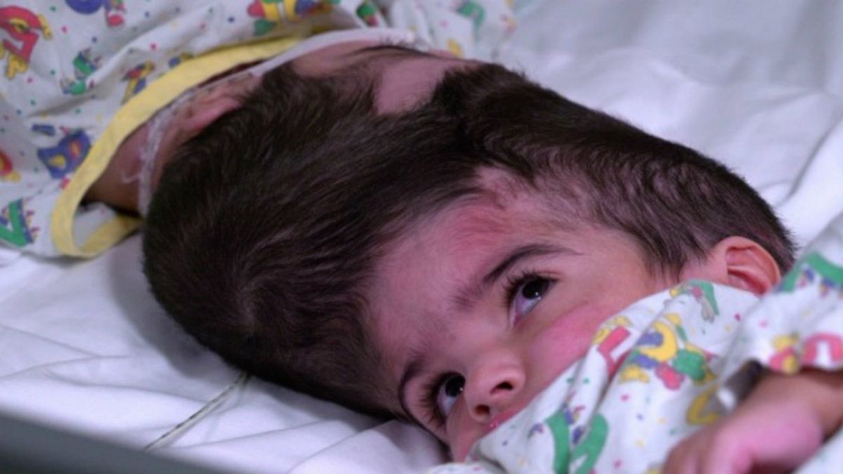 55 órás műtéttel választották szét a fejüknél összenőtt ikreket