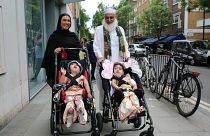 Yapışık ikizler 55 saatlik ameliyatla ayrıldı