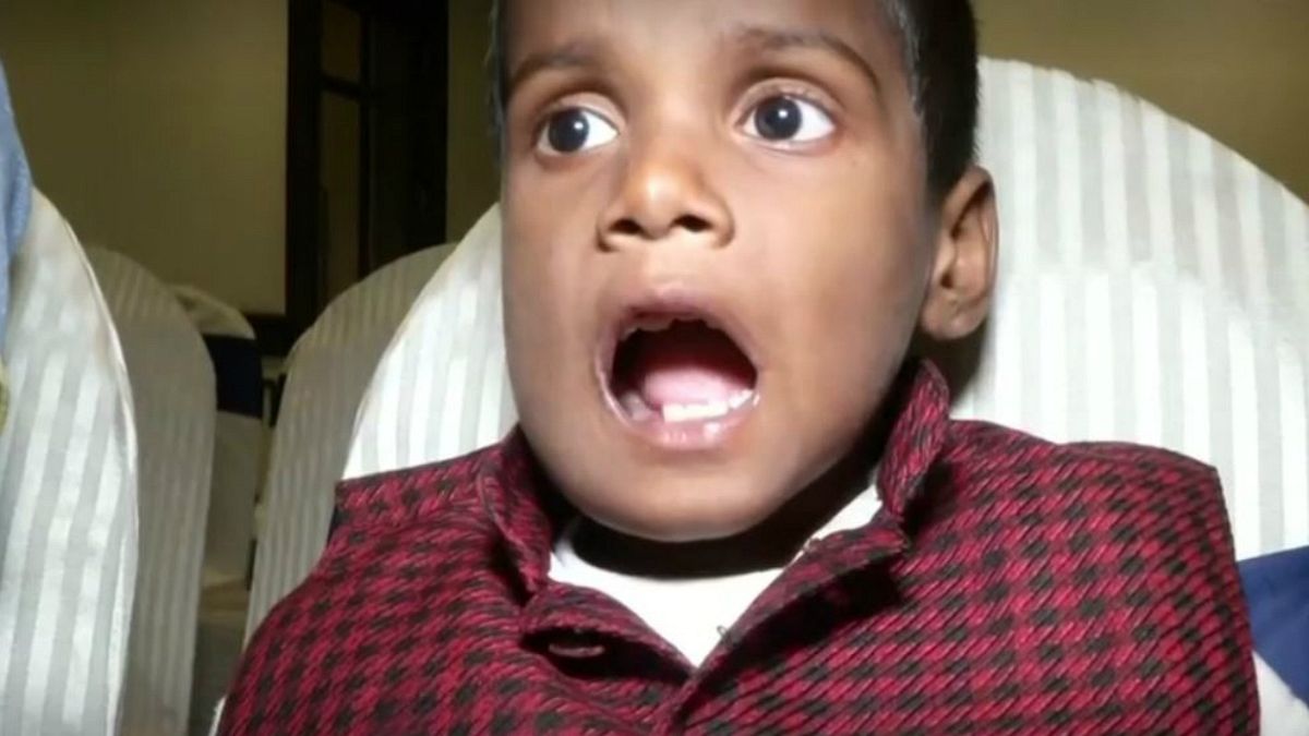 کودک هفت ساله هندی ۵۲۶ دندان اضافی داشت
