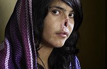 Portrait de Bibi Aisha - Prix World Press Photo of the Year 2010