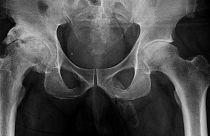 Diz ağrısı şikayetiyle doktora gitti, penisinin tamamen kemikleştiğini öğrendi: Peyronie hastalığı