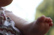 Ισπανία: Ετοιμάζουν μηνύσεις οι γονείς μωρών με «το σύνδρομο του λυκάνθρωπου»